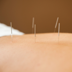 Acupuntura 3 tratamento para dor nos ombros