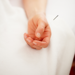 Acupuntura_12 tratamento para enxaqueca