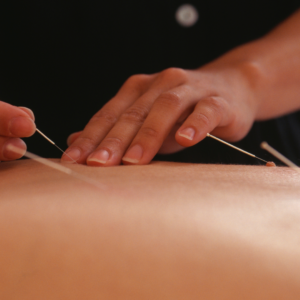 Acupuntura_13 tratamento para TPM com acupuntura