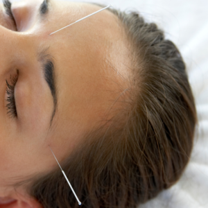 Acupuntura_14 tratamento para sinusite e rinite