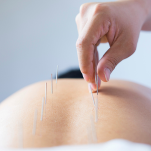 tratamento para infertilidade com acupuntura