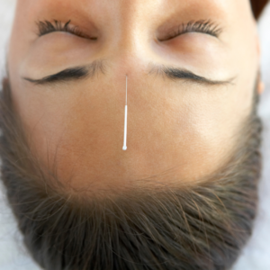 Acupuntura_17 Acupuntura 17