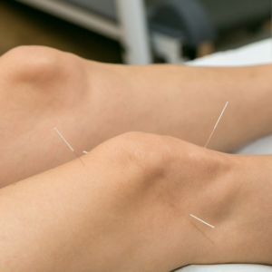 Acupuntura_18 tratamento para alterações intestinais com acupuntura