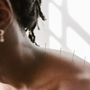 Acupuntura_5 tratamento para ansiedade