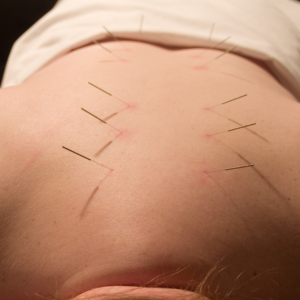 Acupuntura_7 Tratamento para depressão