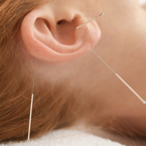 Acupuntura_9 tratamento para bruxismo