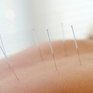 Acupuntura_9 tratamento para fibromialgia