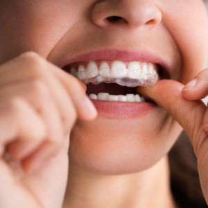 Bruxismo_2 Bruxismo 2