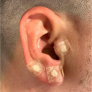 O-que-e-auriculoteraia O que e auriculoteraia